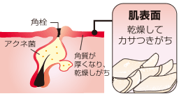 大人ニキビ 典型例