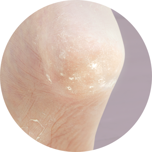 ぷつぷつ皮めくれ&reg;