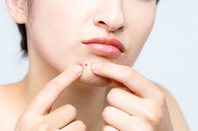 大人ニキビができやすい部位