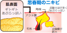 思春期のニキビ