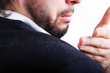 「頭皮湿疹」ってどんな症状？