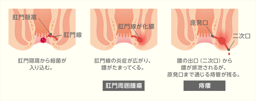 肛門周囲膿瘍と痔瘻（穴痔）
