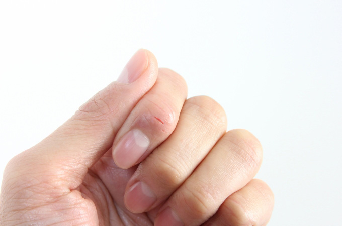 ひび・あかぎれとは