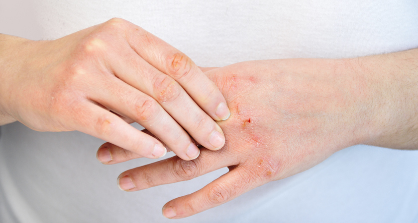 つらいヒビ、あかぎれ、どうにかしたい！冬の正しいハンドケア