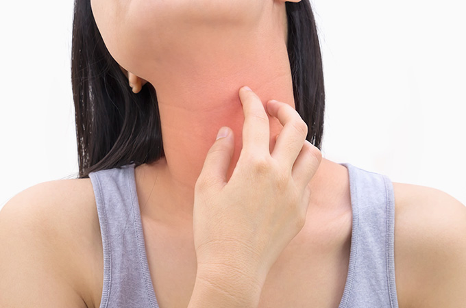 蕁麻疹について