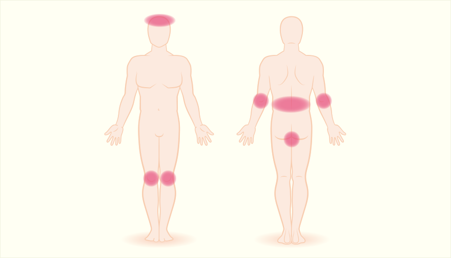 乾癬が見られやすい部位