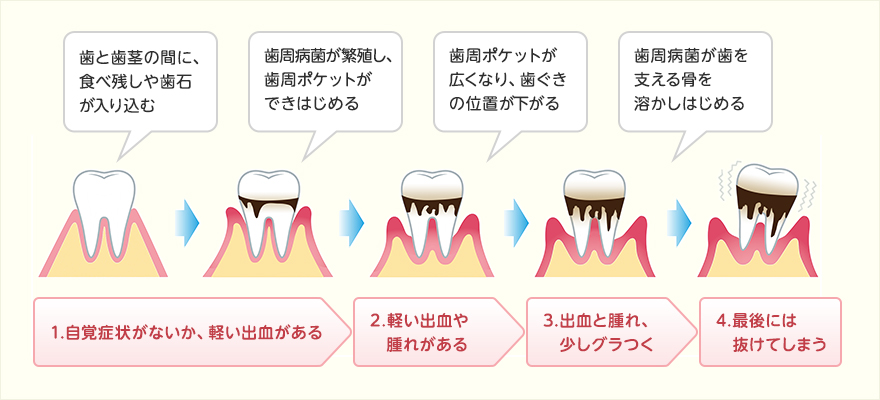 歯槽膿漏（歯周炎）進行ステップ