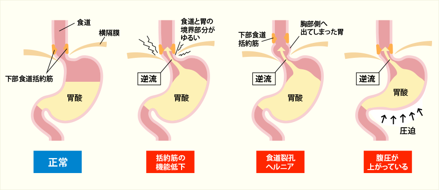 逆流性食道炎の原因・仕組み