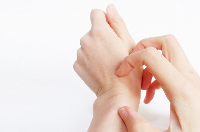 しもやけ（凍瘡）の主な症状