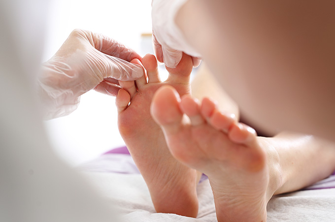 水虫が悪化（末期症状）してしまった？対処方法