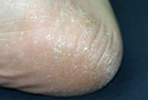 角質増殖型（角化型）