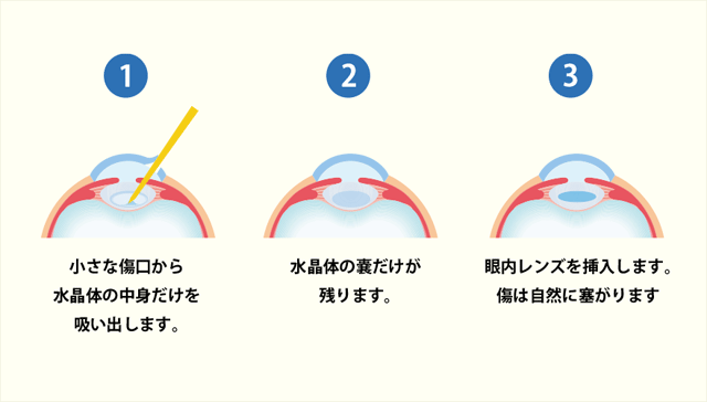白内障の手術方法（超音波乳化吸引法）