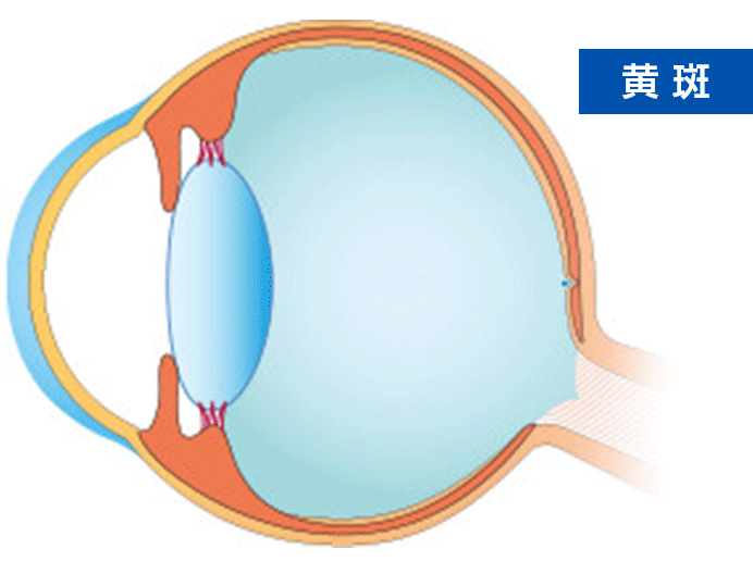 加齢黄斑変性は、どんな病気？