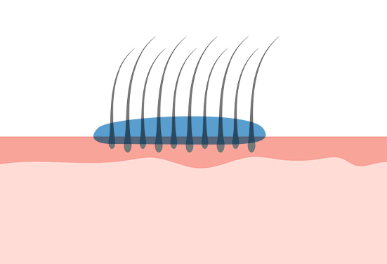 塗布した患部の図