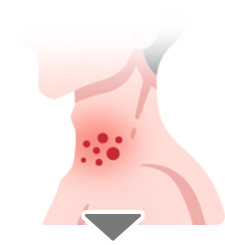 つらいかゆみ赤みを伴う湿疹