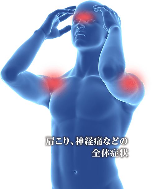 肩こり、神経痛などの全体症状
