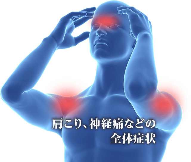 肩こり、神経痛などの全体症状